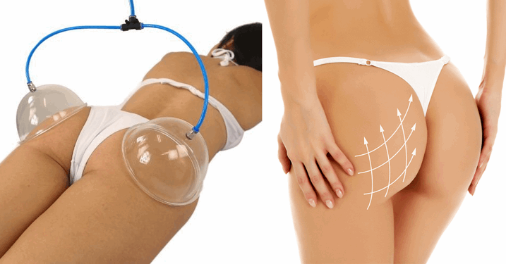 Tratamento Levanta Bumbum: Pump Glteo + Massagem Modeladora por Apenas R$24,90!!!